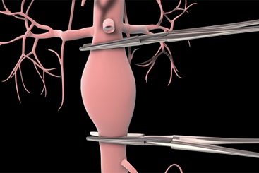 Abdominal Aortic Aneurysm