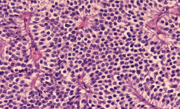 Neuroendocrine Tumors