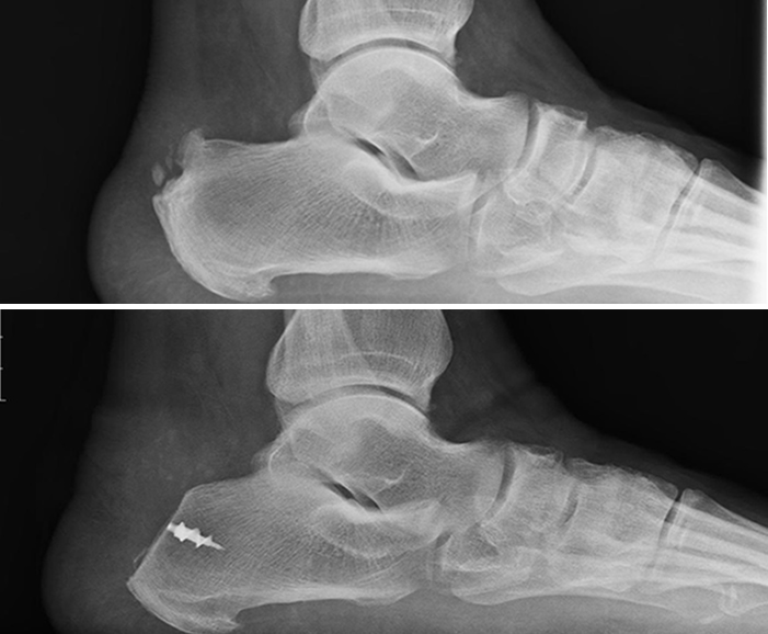 Posterior Heel Spur