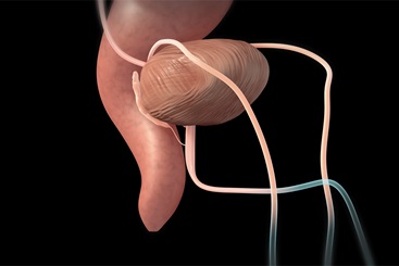 Robotic Prostatectomy