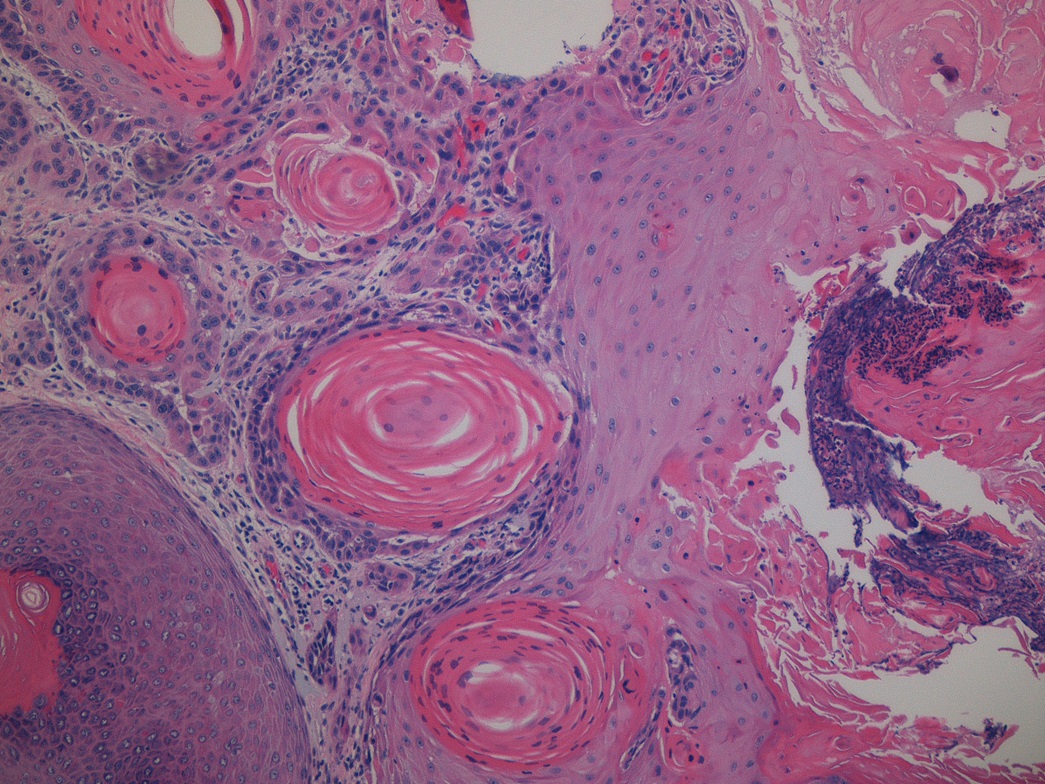 Squamous Cell Carcinoma
