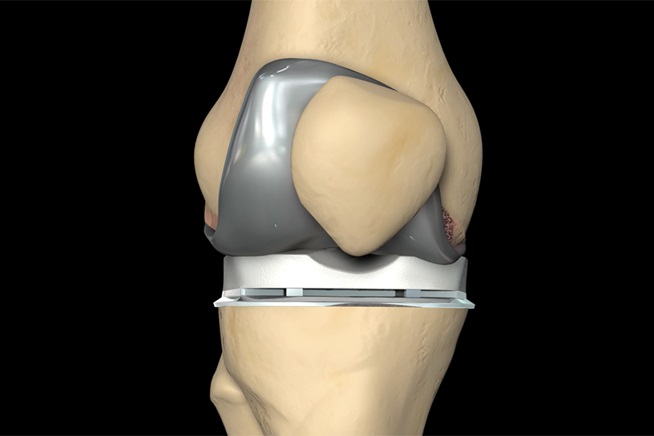 Total Knee Replacement