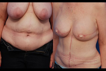 DIEP Flap Breast Reconstruction