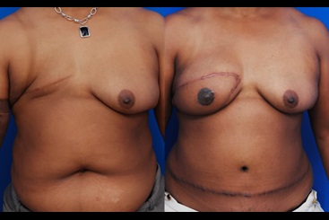 DIEP Flap Breast Reconstruction