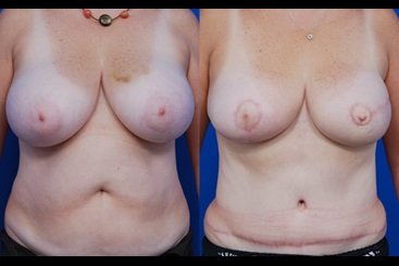 DIEP Flap Breast Reconstruction