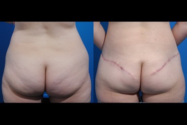 SGAP Flap Reconstruction